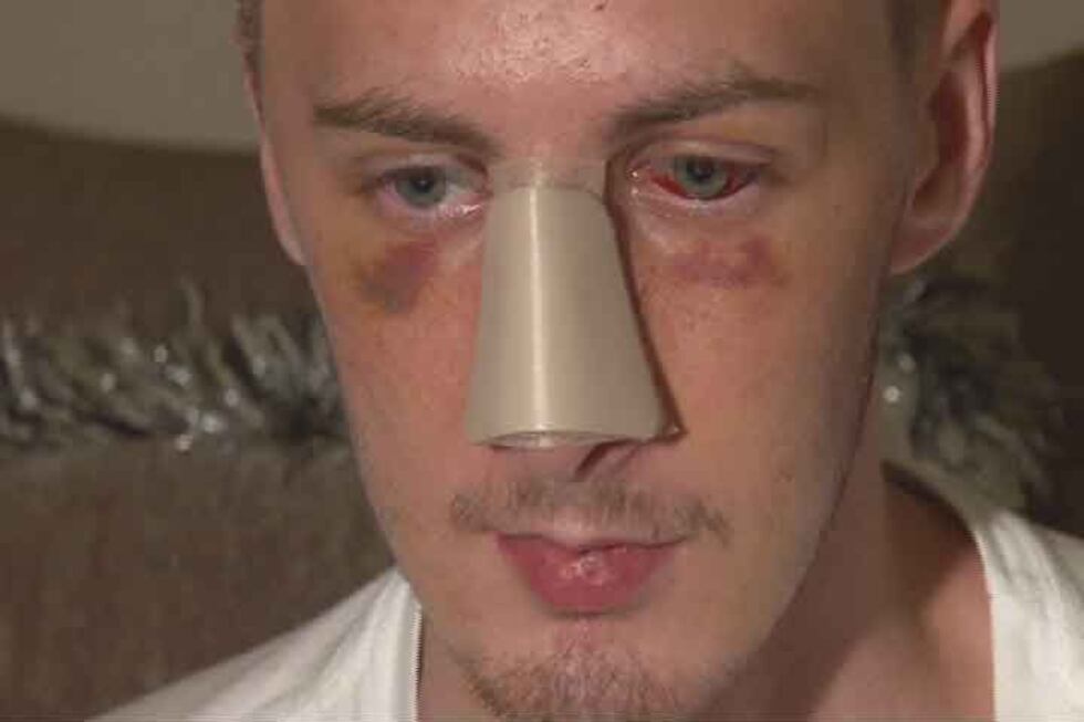 Carter Strange, a week after the beating